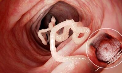 Cum să recunoaștem prezența paraziților în intestinele umane